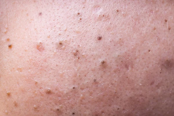 Ugly pimples blackheads on face of teenager — Stock Photo, Image