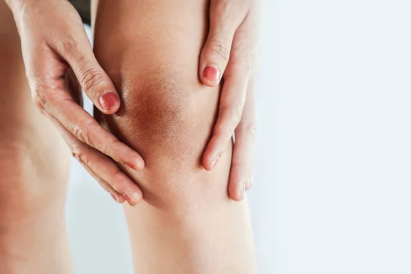 Woman Having Problem Dark Wrinkle Skin Knee — Stock Photo, Image