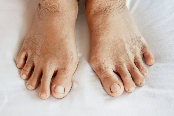 Крупным Планом Женщина Ноги Страдают Боли Суставах Подагрой Пальце — стоковое фото