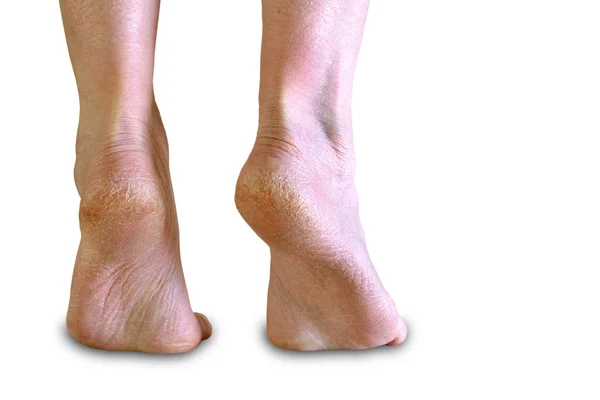 Sucha skóra na obcasach choroba skóry pęknięcia białe tło — Zdjęcie stockowe