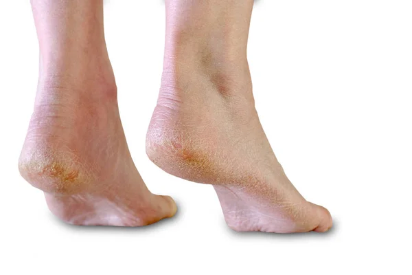 Topukta cilt kuruması cilt hastalıkları ayak hastalıklarını çatlatır.