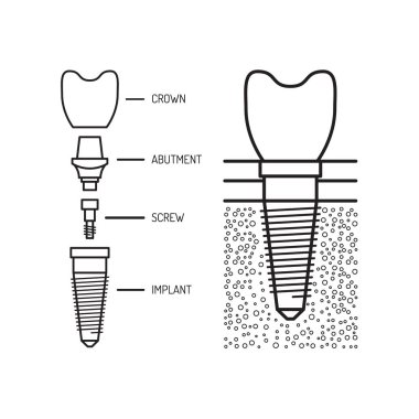 Dental implant vektör