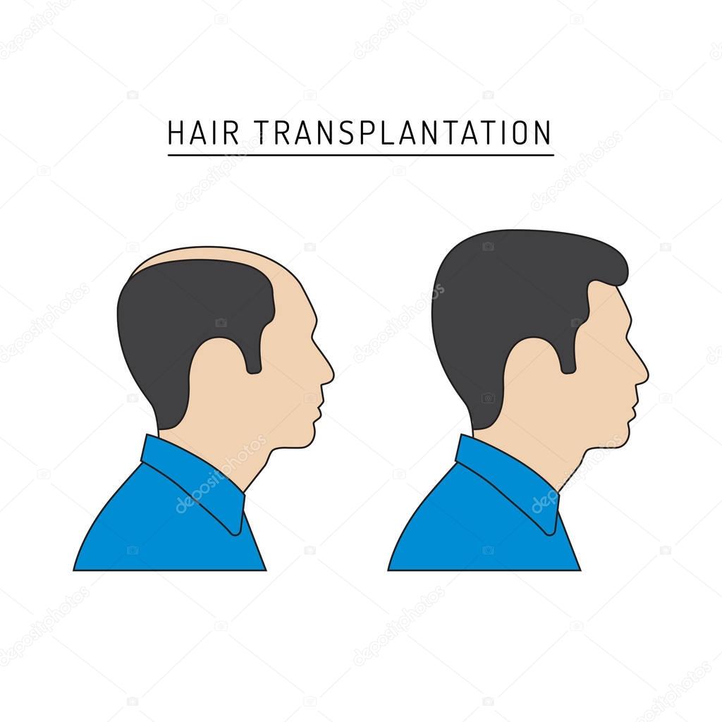 hair transplantation vector