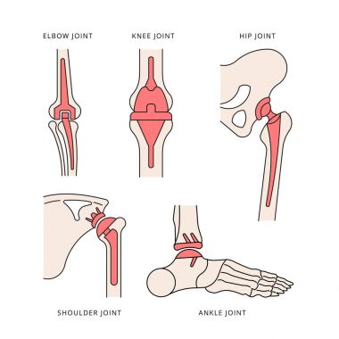implantasyon ortak iskelet