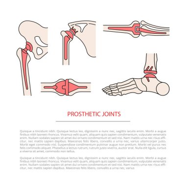 implantasyon ortak iskelet