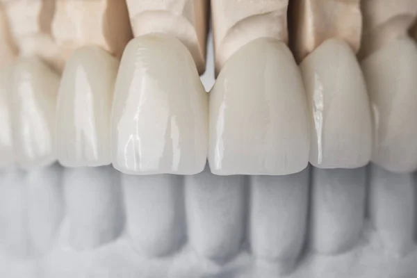 Denti in ceramica nella parte anteriore — Foto Stock