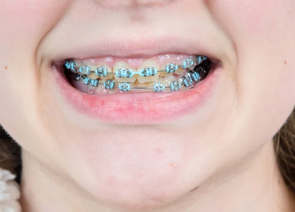 View Braces Attached Girls Teeth — Stock Photo, Image