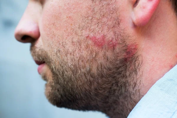 Reacción eruptiva por alergia a medicamentos o alimentos en la cara del hombre caucásico — Foto de Stock
