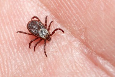 İnsan derisi üzerinde sürünen kenenin makro fotoğrafı. Menenjit ve borrelioz gibi tehlikeli hastalık virüsleri yayan bir parazit..
