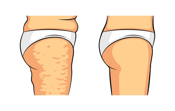 Farbvektorisolierte Illustration Weibliche Beine Seitenansicht Cellulite Den Hüften Weibliche Hüften — Stockvektor