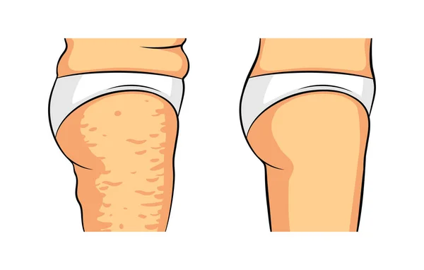 Illustrazione Isolata Vettoriale Colori Gambe Femminili Vista Laterale Cellulite Sui — Vettoriale Stock