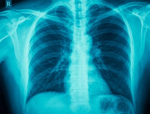 X-ray skanowania ludzkiego klatki piersiowej — Zdjęcie stockowe