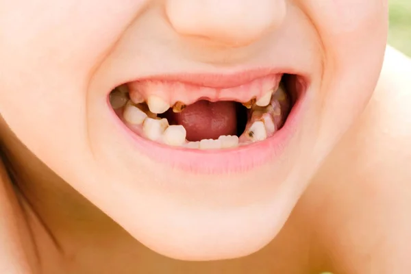 Болезнь зубов или стоматология — стоковое фото
