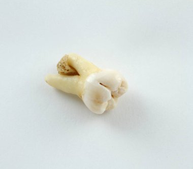 Kağıt üzerinde kemik dokusu bir parça ile sekizinci alt diş çıkarın. Bilgelik diş