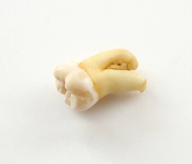 Kağıt üzerinde kemik dokusu bir parça ile sekizinci alt diş çıkarın. Bilgelik diş