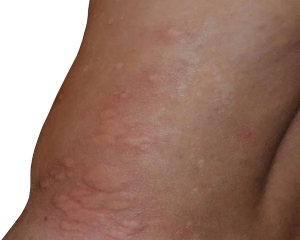 Alergia pele para trás e lados. Reações alérgicas na pele sob a forma de inchaço e vermelhidão — Fotografia de Stock