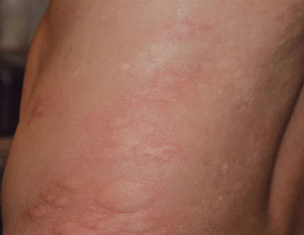 Allergie Haut Rücken und Seiten. Allergische Reaktionen auf der Haut in Form von Schwellungen und Rötungen — Stockfoto