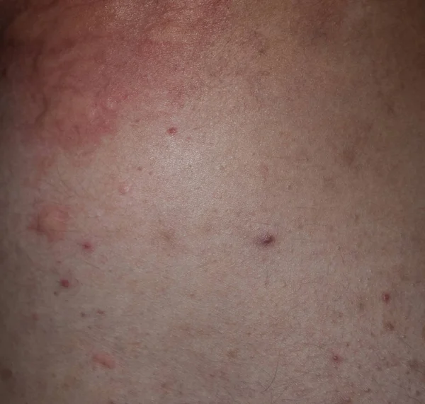 Alergi kulit kembali dan sisi. Reaksi alergi pada kulit dalam bentuk pembengkakan dan kemerahan — Stok Foto
