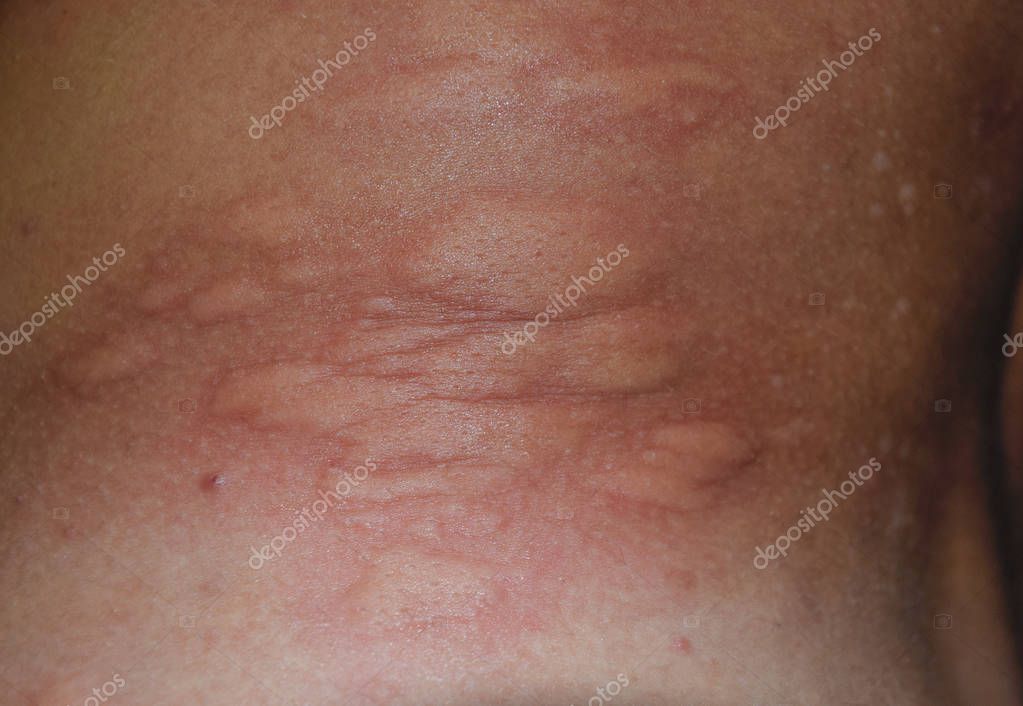 Allergie Haut zurück und an den Seiten. Allergische Reaktionen auf der