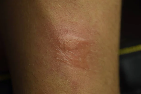 Allergi Huden Allergiska Reaktioner Huden Form Svullnad Och Rodnad — Stockfoto