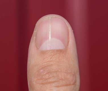 Başparmak çatal çiviye. Dilatasyon tırnak, travmatik patoloji. Çivi ikiye ayrılır.