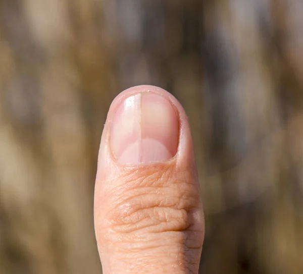 Clavo Bifurcado Pulgar Dilatación Las Uñas Patología Traumática Clavo Divide —  Fotos de Stock