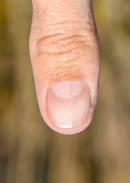 Clavo Bifurcado Pulgar Dilatación Las Uñas Patología Traumática Clavo Divide —  Fotos de Stock