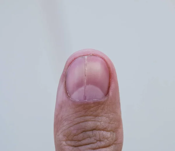 Kluven Spik Tummen Dilatation Nageln Traumatisk Patologi Nageln Uppdelad Hälften — Stockfoto