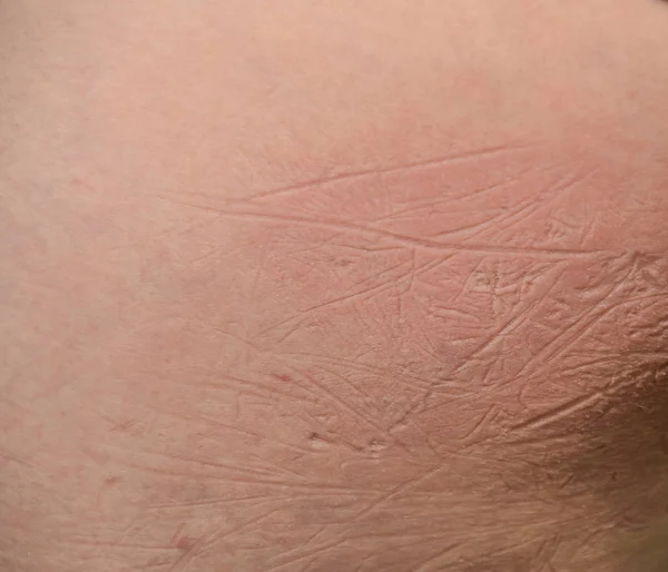 A textura da pele na nádega depois de um longo sentado na grama. Uma bunda estendida — Fotografia de Stock