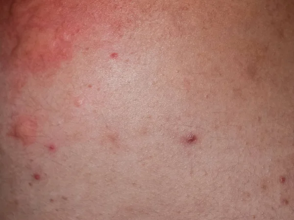 Алергія на шкіру спини та боків. Алергічні реакції на шкіру у вигляді набряків і почервоніння — стокове фото