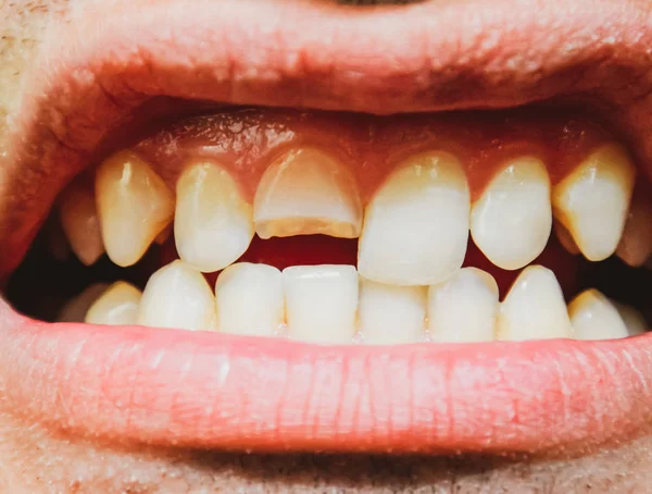 Сломанный зуб. Сломанный верхний резец во рту мужчины . — стоковое фото