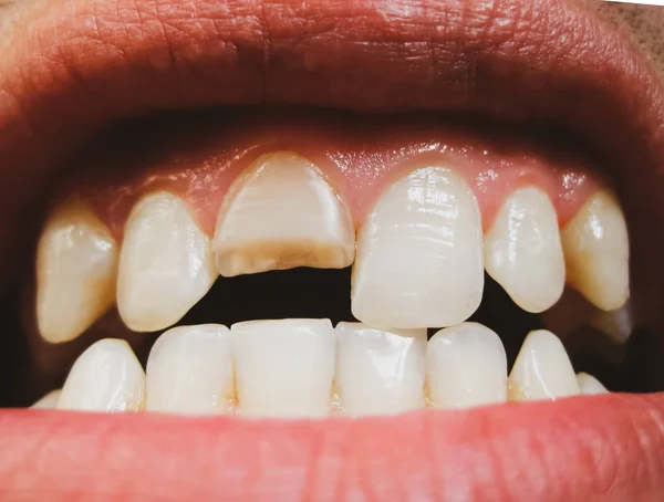 Сломанный зуб. Сломанный верхний резец во рту мужчины . — стоковое фото