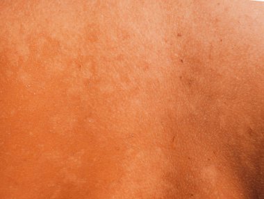 Arka ciltte güneş yanığı. Pul pul dökülme, cilt peeling. Tehlikeli güneş tan