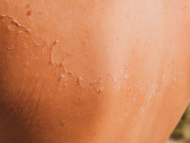 Arka ciltte güneş yanığı. Pul pul dökülme, cilt peeling. Tehlikeli güneş tan