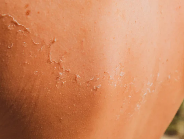 Quemaduras solares en la piel de la espalda. La exfoliación, la piel se desprende. Peligroso bronceado —  Fotos de Stock