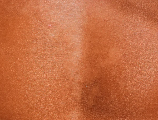 Quemaduras solares en la piel del estómago. La exfoliación, la piel se desprende. Peligroso bronceado — Foto de Stock