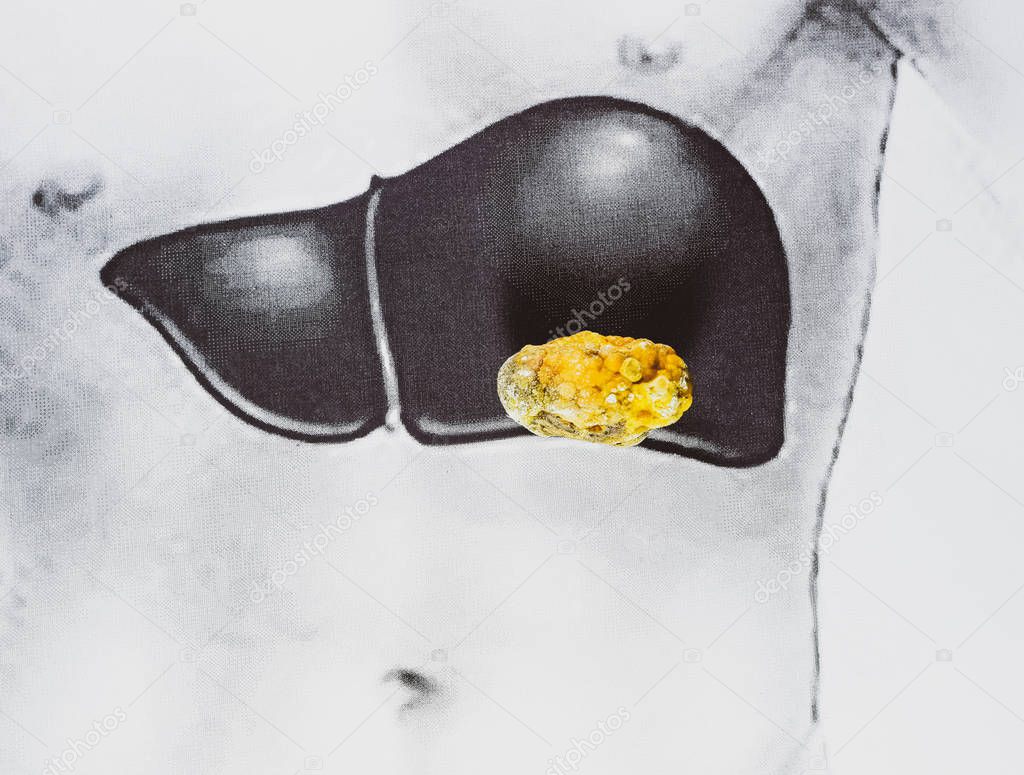 stone in the liver, schematic image, a large gallstone, the result of gallstones.