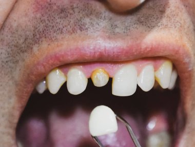 Diş implantasyonu, diş tedavisi.