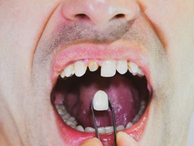 Diş implantasyonu, diş tedavisi.