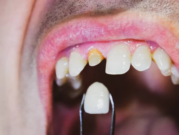 Tandimplantatie, tandheelkundige behandeling. — Stockfoto