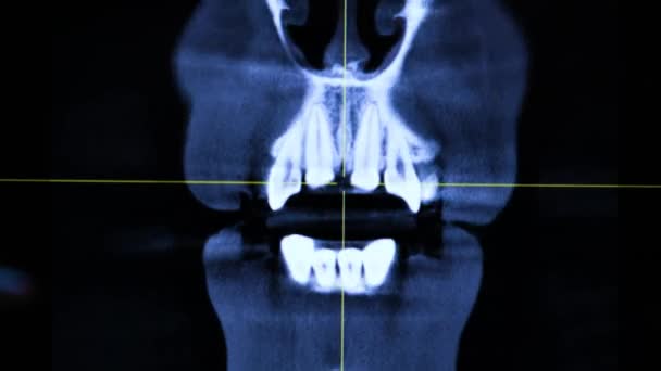 Příznaky bolesti zubů. X-ray lidské čelisti v počítači. Lékař zkoumá pacientů čelisti, léčí zub. — Stock video