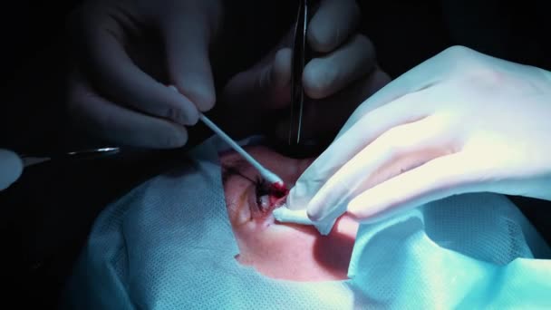 De chirurg is er een bewerking op de ogen, close-up. Correctie van ogen en ogen. De dokter doet blepharoplastiek. Operatie in de operatiekamer. Scalpel en klem zeer dicht bij de leerling — Stockvideo