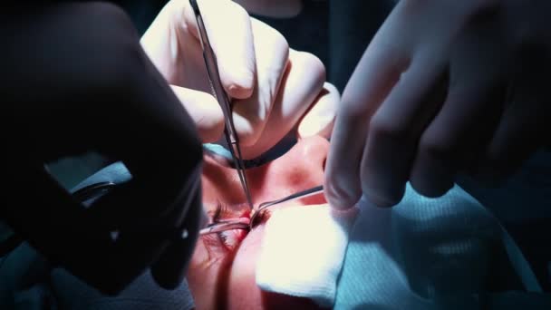 El cirujano está realizando una operación en los ojos, de cerca. Corrección de ojos y ojos. El médico hace blefaroplastia. Operación en el quirófano. Escalpelo y pinza muy cerca de la pupila — Vídeo de stock