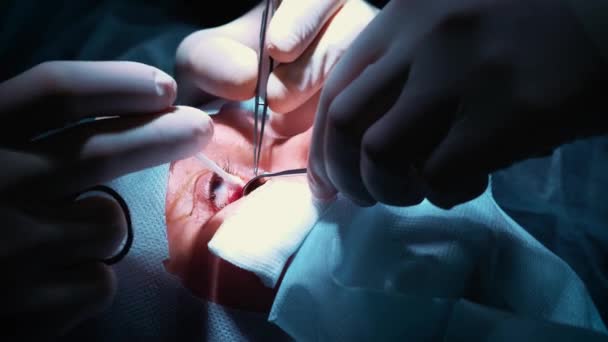 De chirurg is er een bewerking op de ogen, close-up. Correctie van ogen en ogen. De dokter doet blepharoplastiek. Operatie in de operatiekamer. Scalpel en klem zeer dicht bij de leerling — Stockvideo