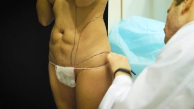 kalın yaşlı kadın tıbbi liposuction için hazırlar. Doktor marker, karın üzerinde işareti çizer. Cerrah biçimlendirme işlemi önce liposuction tarafından hastaya kadına çizer