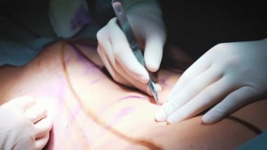 Cerrah ve ameliyat ekibi kozmetik cerrahi Hastanesi ameliyathane göğüs üzerinde performans. Göğüs büyütme. Göğüs büyütme. Liposuction. Acil bakım. Cerrahi detay.