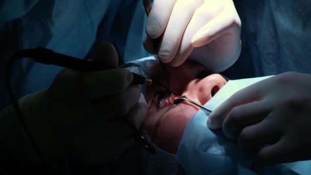The surgeon is performing an operation on the eyes, close-up. Correction of eyes and eyes. The doctor does blepharoplasty. Operation in the operating room. Scalpel and clamp very close to the pupil — Stock Video