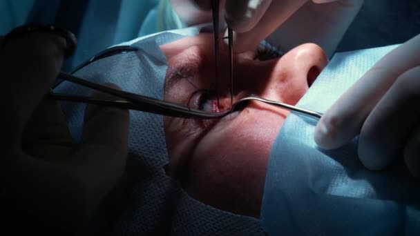 The surgeon is performing an operation on the eyes, close-up. Correction of eyes and eyes. The doctor does blepharoplasty. Operation in the operating room. Scalpel and clamp very close to the pupil — Stock Video