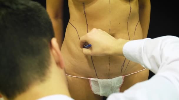 Thick elderly woman prepares to medical liposuction. Doctor draws marker, mark on the abdomen. The surgeon draws the markup before the operation by liposuction on the patient to the woman — Stock Video
