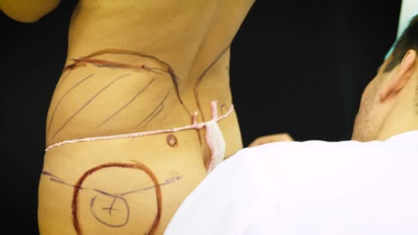 Femme âgée épaisse se prépare à la liposuccion médicale. Le docteur dessine un marqueur, marque sur l'abdomen. Le chirurgien établit le balisage avant l'opération par liposuccion sur le patient à la femme — Video